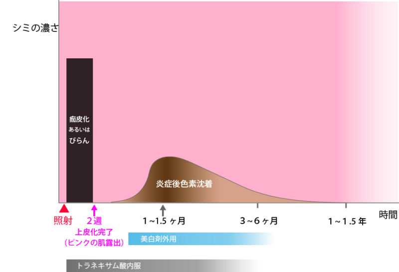 レーザー照射後の炎症後色素沈着の経過