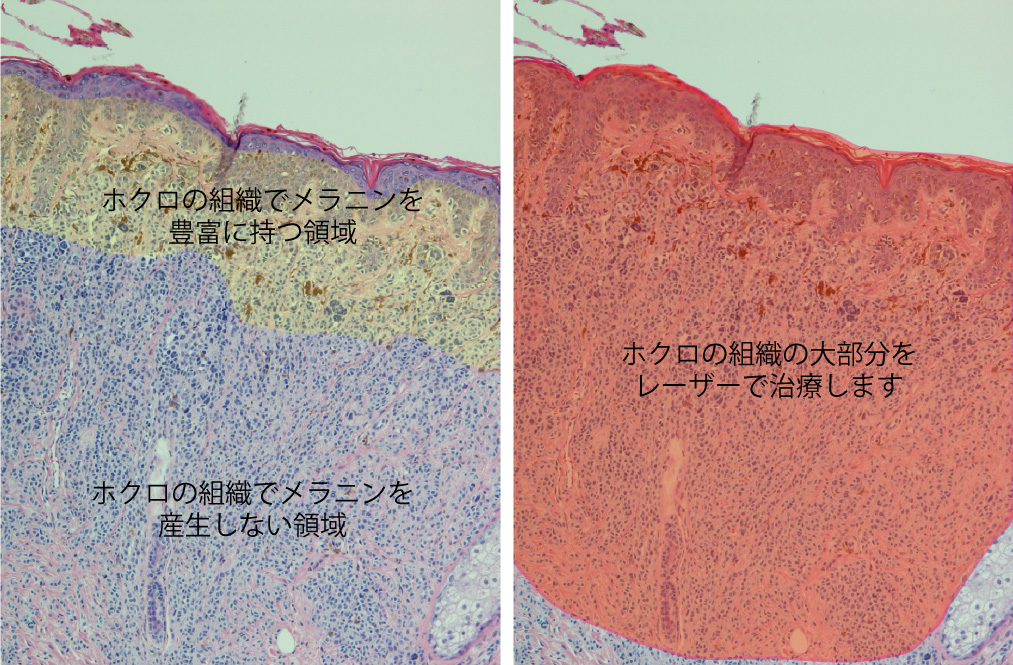 ホクロの病理組織　再発がないための切除範囲