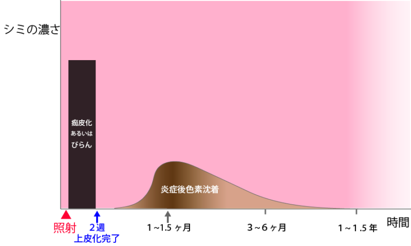 脂漏性角化症治療後の炎症性色素沈着の経過の図