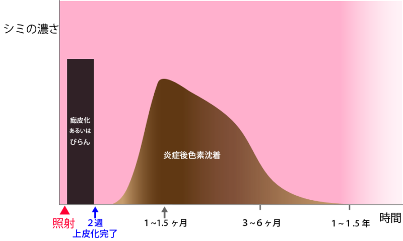 脂漏性角化症レーザー治療後に炎症性色素沈着が濃く長期間にわたる場合の図