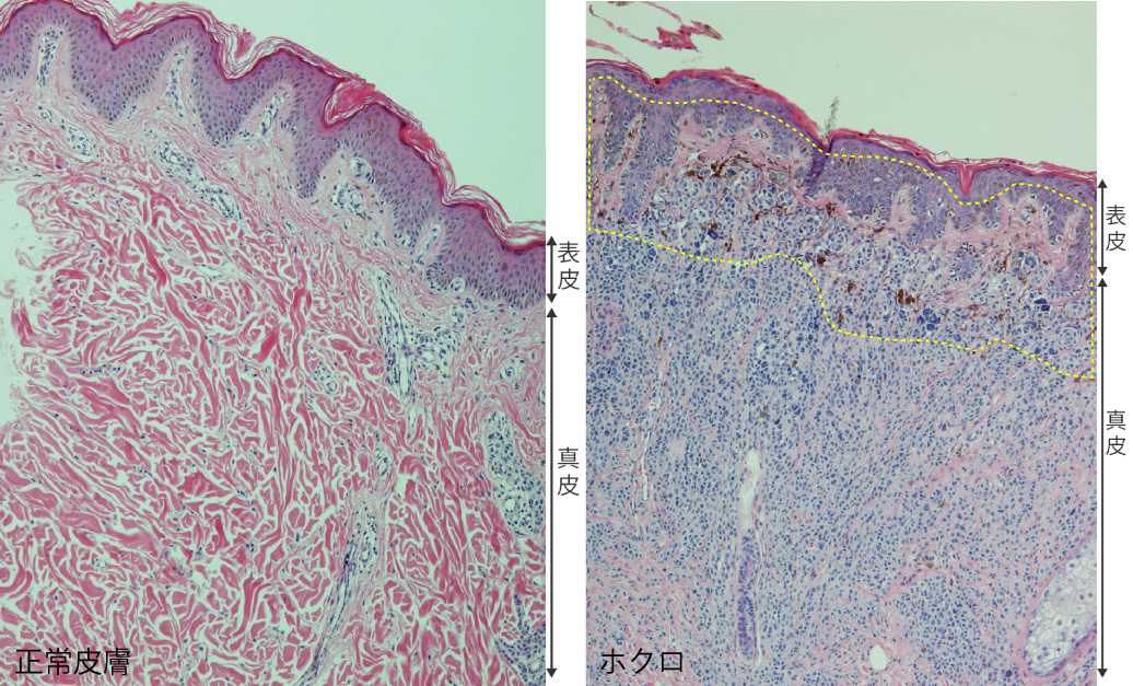 写真説明）正常皮膚とホクロの病理組織像