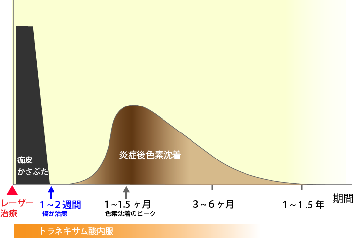 イボのレーザー治療後の色素沈着の経過