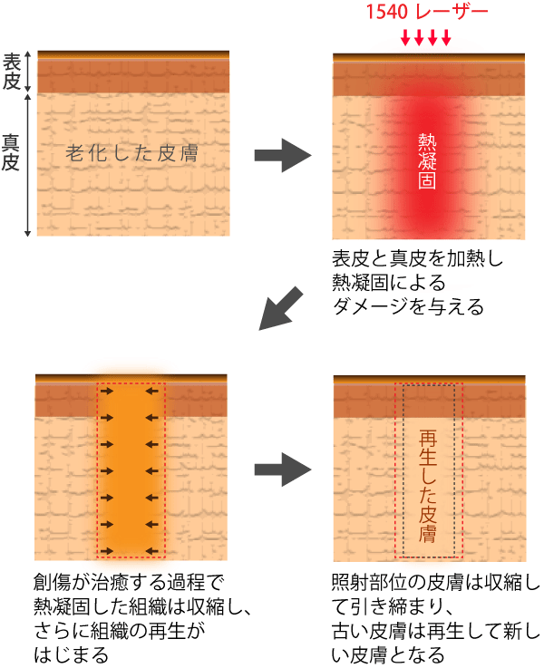 肌のリモデリング