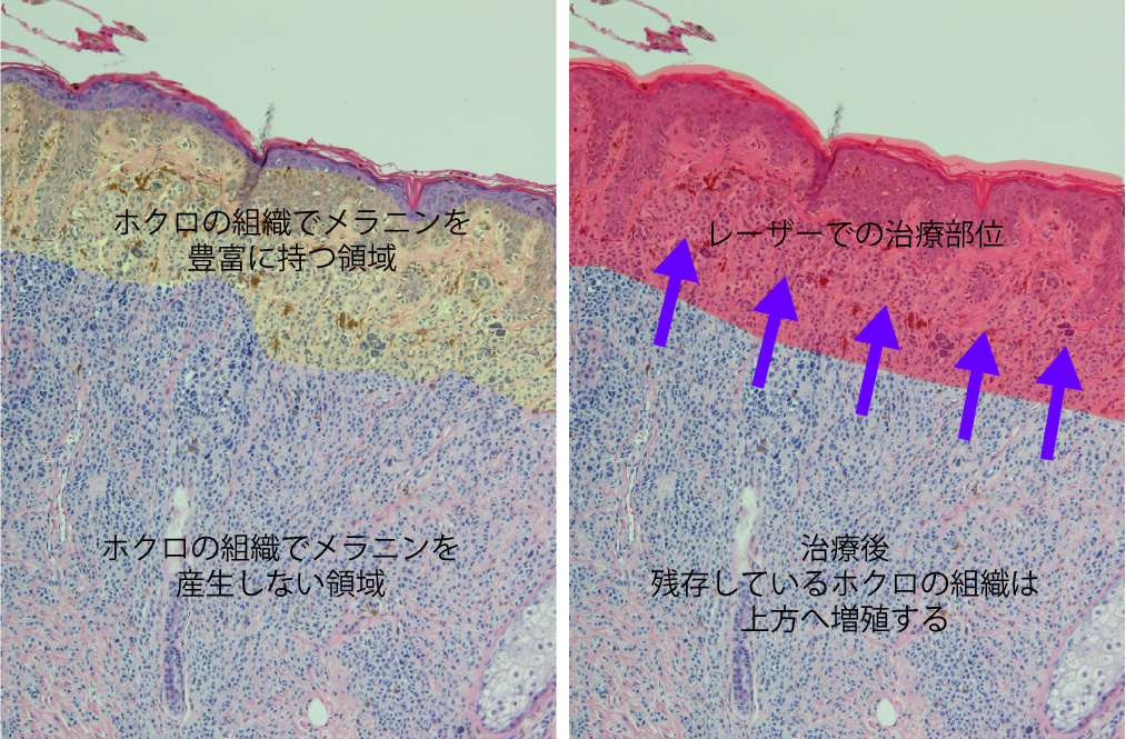 ホクロの病理組織