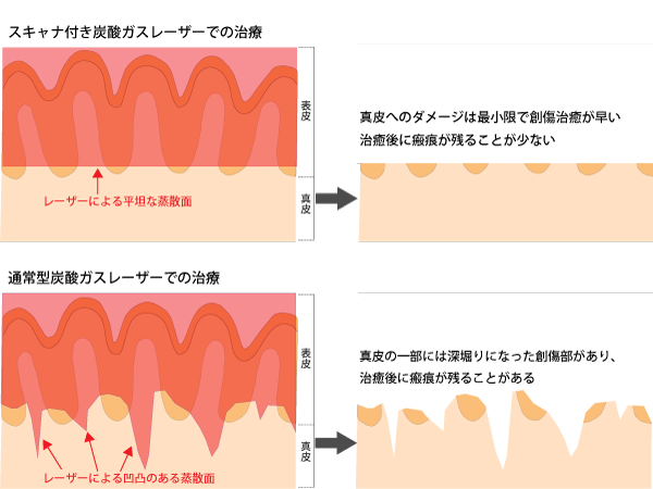 スキャナ付きと通常型レーザーでのイボ除去比較