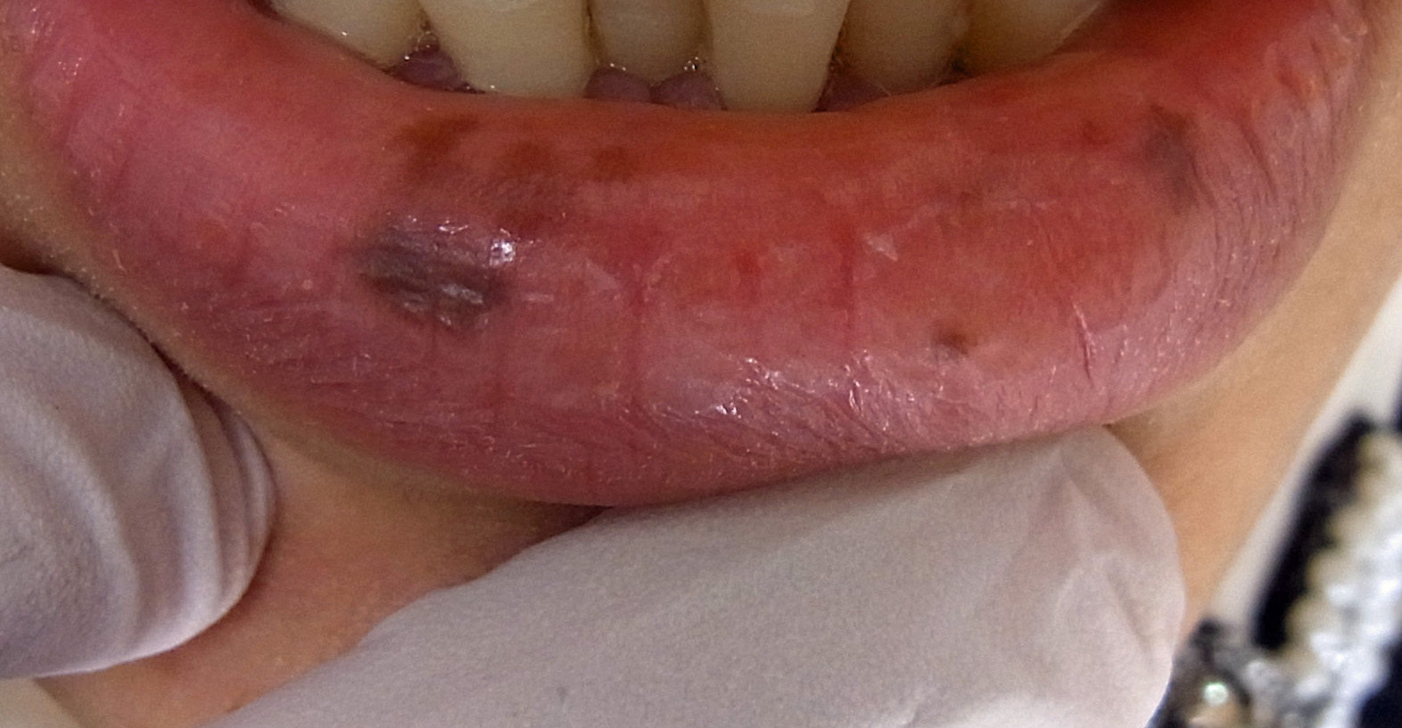 labial melanotic macule